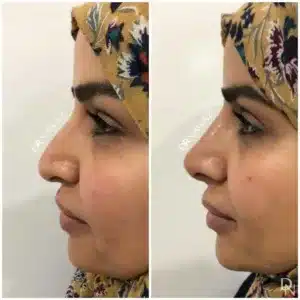 Aesthetic treatment before and after result by Dr Nawaz - Aesthetic Clinic Knightsbridge London