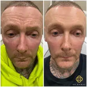 Before and After Anti-Wrinkle Treatment Results by Dr Nawaz