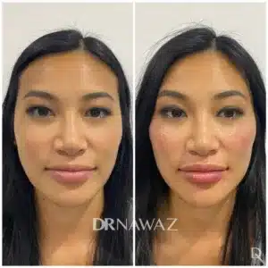 Before and After Treatment Results by Dr Nawaz - Aesthetic Clinic Dubai