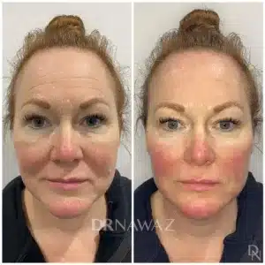 Before and After results performed at Dr Nawaz - Aesthetic Clinic Dubai